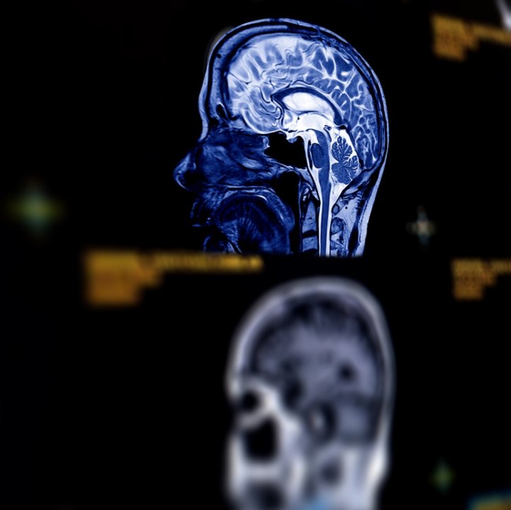 recherches scientifiques sur la maladie d'Alzheimer et les troubles de la mémoire qui affectent le cerveau